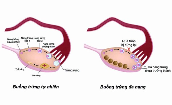 Cô gái 17 tuổi mọc râu đen đậm, đi khám không ngờ do bệnh phụ khoa - Ảnh 2.