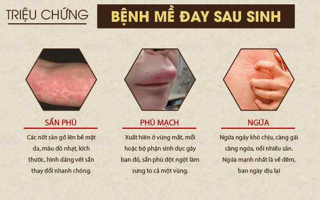 Nổi mề đay sau sinh: Triệu chứng và cách chữa hiệu quả bằng thuốc nam - Ảnh 1.