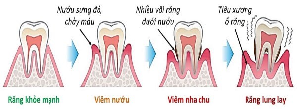 Cảnh báo: Viêm nha chu có thể gây rụng răng - Ảnh 1.