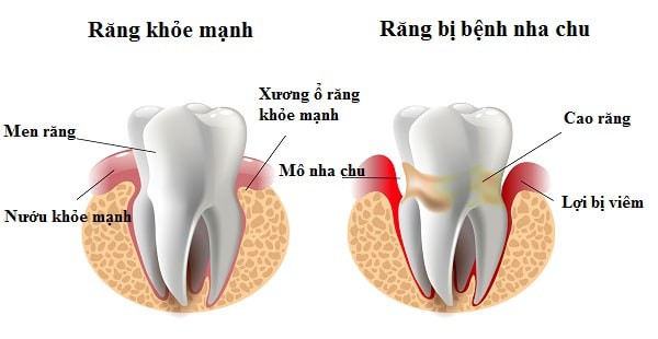 Cảnh báo: Viêm nha chu có thể gây rụng răng - Ảnh 3.