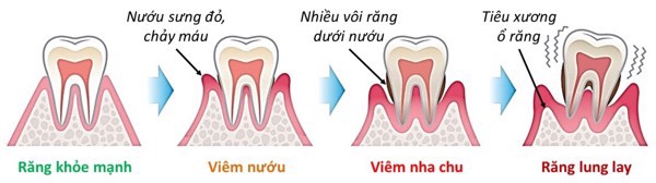 Bác sĩ mách bạn cách để không bị mất răng vì viêm nha chu - Ảnh 1.