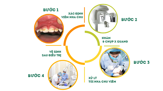 Bác sĩ mách bạn cách để không bị mất răng vì viêm nha chu - Ảnh 2.