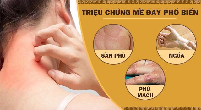 Nổi mề đay mẩn ngứa là gì? Triệu chứng và cách chữa trị hiệu quả           - Ảnh 1.