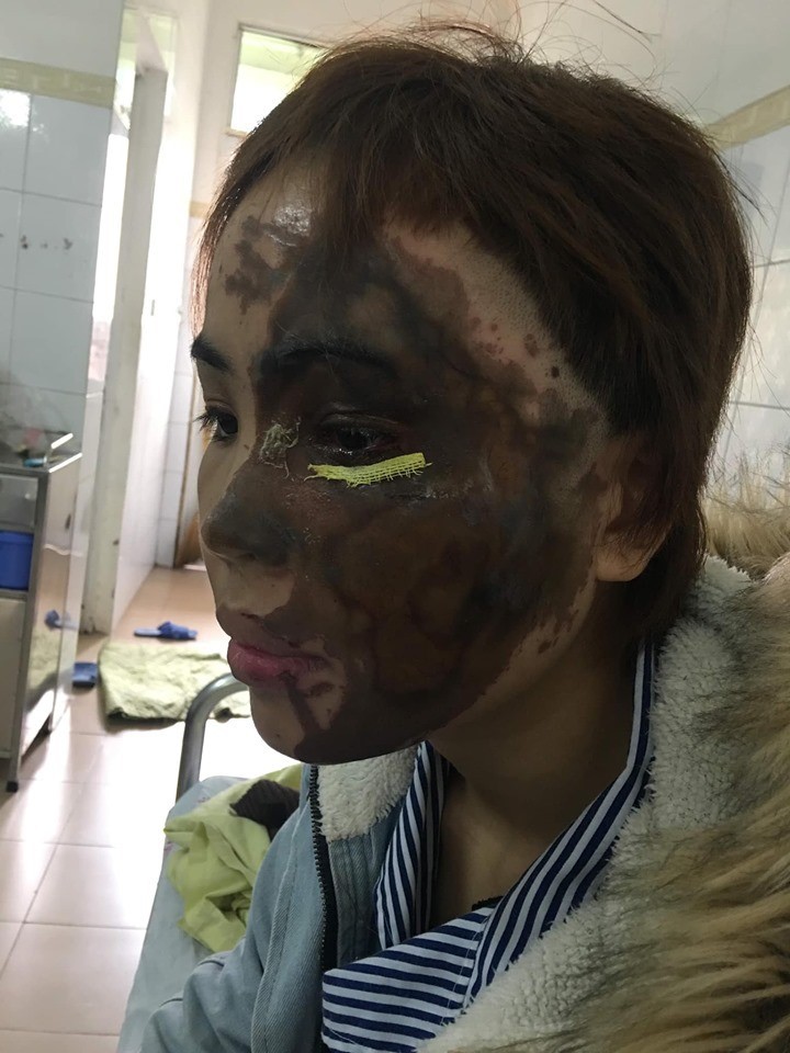 C&ocirc; g&aacute;i bị chồng sắp cưới l&agrave; Thiếu &uacute;y c&ocirc;ng an tạt axit: C&oacute; ai bắt được em ngủ với trai chưa? - Ảnh 1.