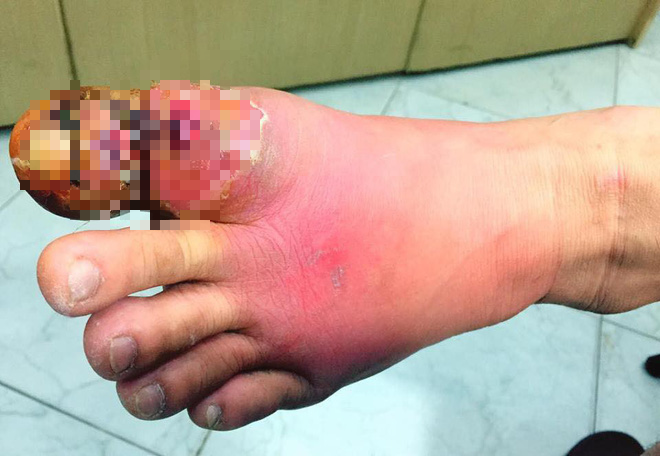 Cắt khóe móng chân tại nhà, một phụ nữ bị hoại tử nhiễm trùng nặng bàn chân - Ảnh 1.