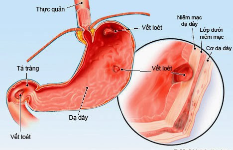 Dấu hiệu sớm của ung thư dạ dày: Nếu biết để phát hiện kịp thời, cơ hội khỏi bệnh rất cao - Ảnh 1.