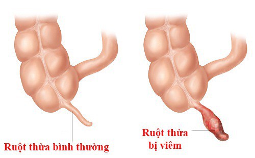 Một số dấu hiệu ung thư ruột thừa - Ảnh 1.