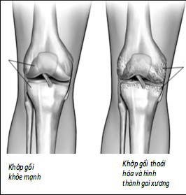 Thủ phạm khiến bạn đau đầu gối - Ảnh 1.