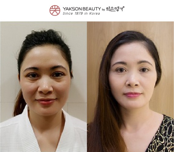 Đẹp tự nhiên bằng liệu pháp Golki truyền thống tại Yakson Beauty  - Ảnh 3.