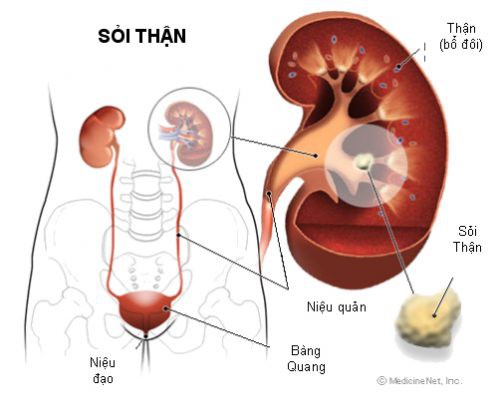 Bác sĩ mách chế độ ăn cho người bị sỏi thận, sỏi tiết niệu - Ảnh 2.