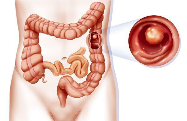 Triệu chứng phổ biến của polyp đại trực tràng, nếu phát hiện nên khám để hạn chế biến chứng - Ảnh 1.