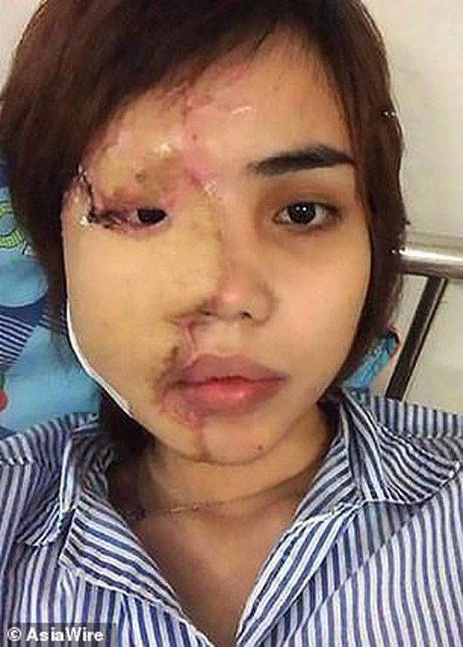 Dân mạng nước ngoài bày tỏ sự thương cảm với cô gái Việt Nam bị chồng sắp cưới tạt axit đến biến dạng khuôn mặt - Ảnh 5.