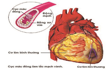 Cách chặn nguy cơ đột quỵ và bệnh tim mạch - Ảnh 1.