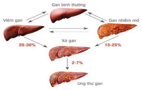 Bài thuốc chữa bệnh gan do rượu - Ảnh 1.