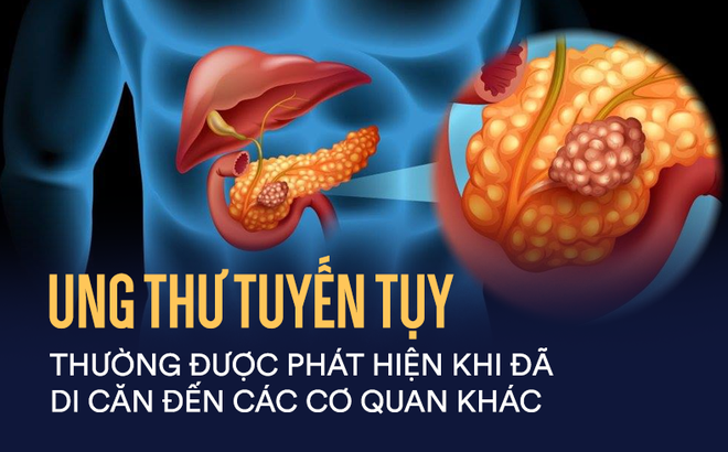 Căn bệnh ung thư cực kỳ nguy hiểm, tỷ lệ sống chỉ được 5%: Dấu hiệu nào nhận biết bệnh? - Ảnh 2.