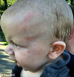 Nôn mửa không ngừng, bé trai 6 tháng tuổi bị chẩn đoán chảy máu não, nghi ngờ do bảo mẫu bạo hành, trên mặt còn nguyên dấu vết bị đánh - Ảnh 3.