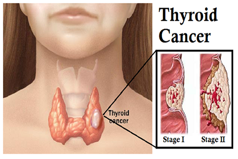 16 tuổi mắc ung thư tuyến giáp: Bệnh này có đáng sợ? - Ảnh 1.