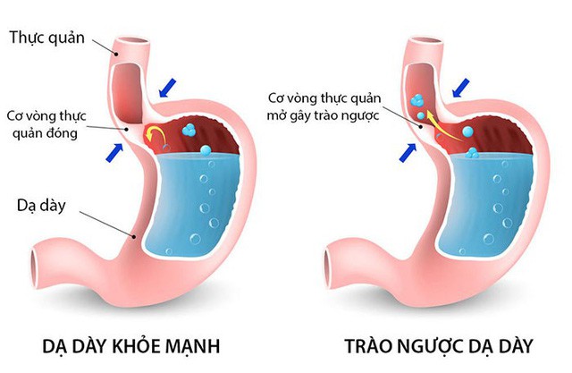 Nóng rát ở vùng xương ức: Căn bệnh nguy hiểm có thể dẫn tới ung thư - Ảnh 2.