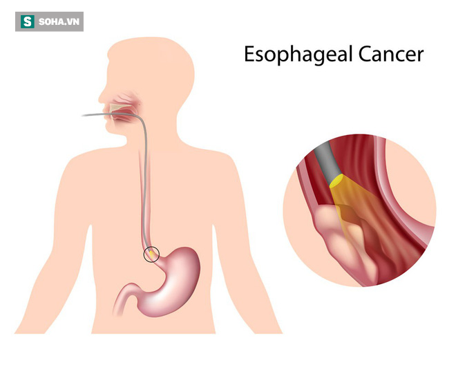 4 nhóm người có nguy cơ mắc ung thư thực quản đặc biệt cao: Hãy chú ý ngăn chặn sớm - Ảnh 1.