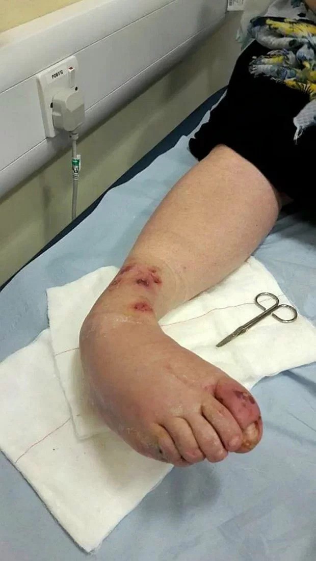 Bị lọ nước hoa rơi trúng chân, người phụ nữ chịu đựng nỗi đau suốt 2 năm trước khi buộc phải cắt bỏ một phần chân - Ảnh 2.