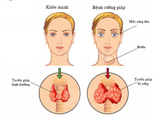 Bệnh cường giáp và các biến chứng tim mạch - Ảnh 1.