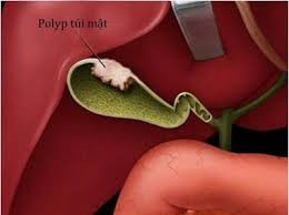 Khi nào cần cắt bỏ polyp túi mật? - Ảnh 1.