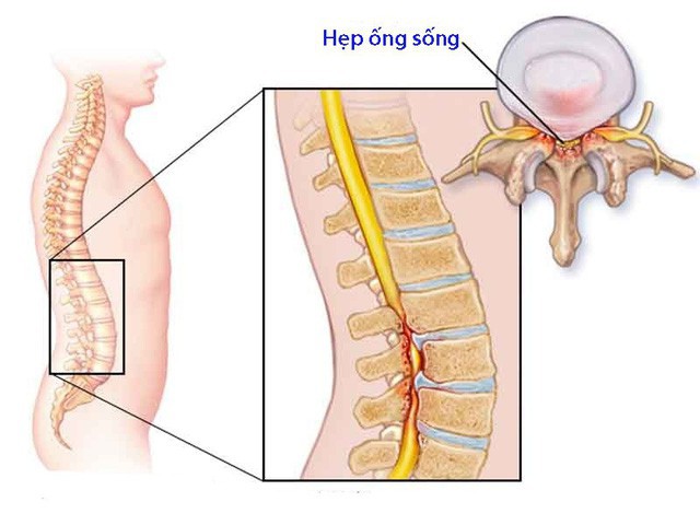 Đau lưng khi ho - tưởng không bệnh mà nhiều bệnh không tưởng - Ảnh 2.