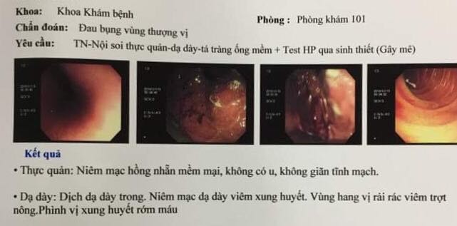 Bố mẹ khốn khổ điều trị viêm dạ dày cho con và bài học: Đừng dùng chung bát nước chấm nữa! - Ảnh 1.