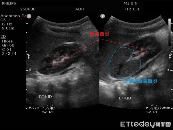 Bé trai sốt 5 ngày không khỏi, nhiễm trùng cao gấp 13 lần thông thường: Bác sĩ nhắc mẹ việc cần làm khi con bị sốt - Ảnh 2.