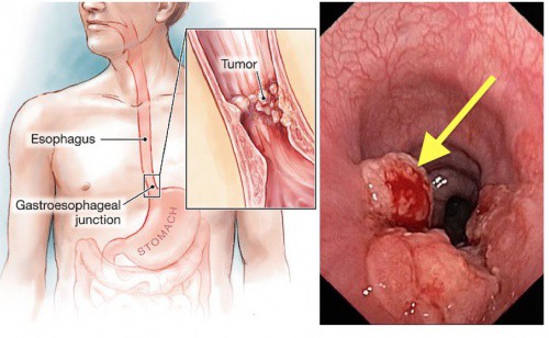 Bị ung thư lại tưởng viêm họng: 3 dấu hiệu điển hình cần nhớ, ai có cần đi khám sớm - Ảnh 1.