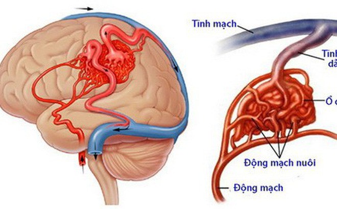 Đang dự thi, thí sinh Hà Tĩnh đột ngột liệt nửa người: Căn bệnh nguy hiểm thế nào? - Ảnh 2.