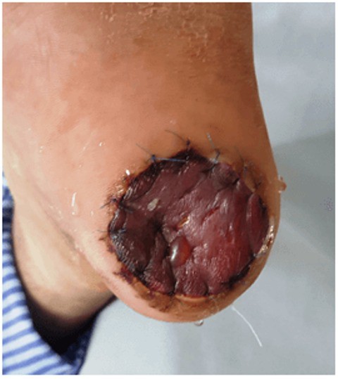Thấy đốm đen ở gót chân, người đàn ông không ngờ mắc ung thư da - Ảnh 2.