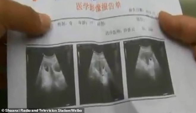 Phá thai được 1 tuần thì phát hiện con vẫn lớn lên trong bụng, người phụ nữ tá hỏa khi biết bác sĩ phẫu thuật nhầm - Ảnh 2.