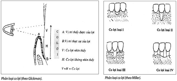 Ðừng coi thường hậu quả của co lợi - Ảnh 1.