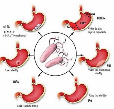 Nhiễm vi khuẩn HP có đáng lo? - Ảnh 1.