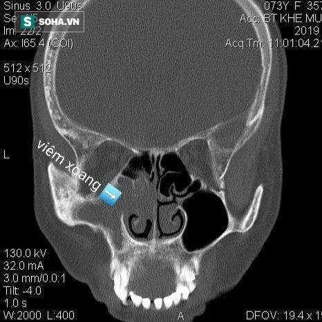 Căn bệnh ca sĩ Cẩm Ly đang mắc nguy hiểm tới đ&acirc;u m&agrave; b&aacute;c sĩ khuyến c&aacute;o phải dừng h&aacute;t? - Ảnh 1.