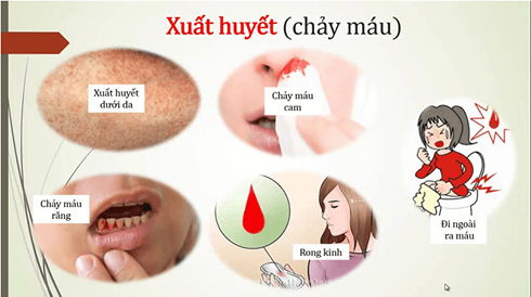 Bác sĩ chỉ rõ 2 biến chứng nguy hiểm của sốt xuất huyết, dấu hiệu cảnh báo cần đến viện ngay - Ảnh 2.