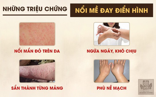 Nổi mề đay mẩn ngứa: Triệu chứng và cách chữa trị hết dị ứng, nổi mẩn đỏ - Ảnh 3.