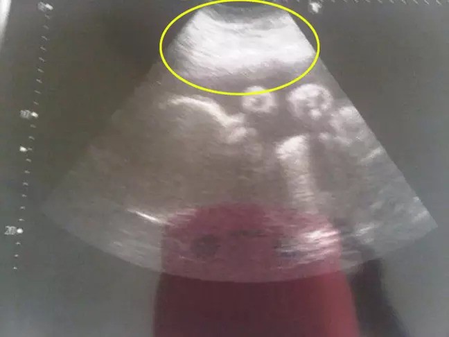 Đang mang thai tháng thứ 9, người phụ nữ đột ngột ngất xỉu trước khi phát hiện điều kỳ lạ trong buồng trứng khiến cô mãn kinh ở tuổi 23 - Ảnh 2.