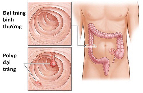 Phòng ngừa táo bón ở người cao tuổi - Ảnh 1.