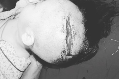 Hà Nội: Cháu bé 2 tuổi trẻ bị chó tấn công lộ xương sọ - Ảnh 1.