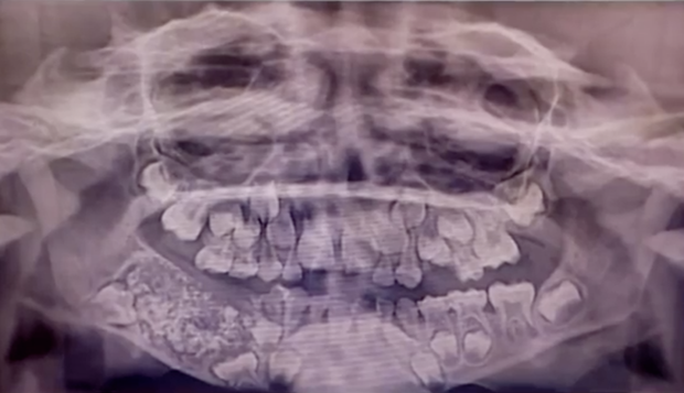 Thấy miệng con sưng to, bố mẹ đưa đi khám thì ngã ngửa khi bác sĩ phẫu thuật nhổ ra 526 chiếc răng to bé đủ loại - Ảnh 1.