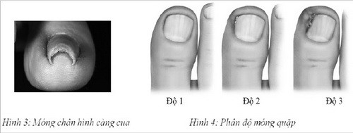 Móng quặp, chữa trị thế nào? - Ảnh 1.