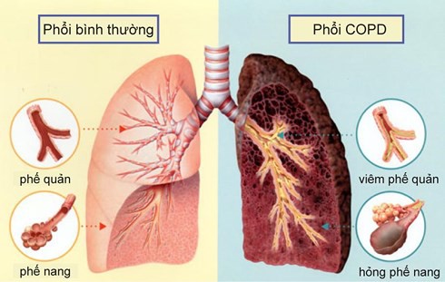 Mắc căn bệnh này chẳng khác nào ung thư phổi - Ảnh 1.