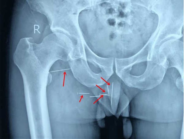 Người đàn ông bị đau ngứa ở mông suốt một thập kỉ, đến bác sĩ kiểm tra mới tá hỏa phát hiện 8 chiếc kim tiêm bị kẹt bên trong - Ảnh 1.