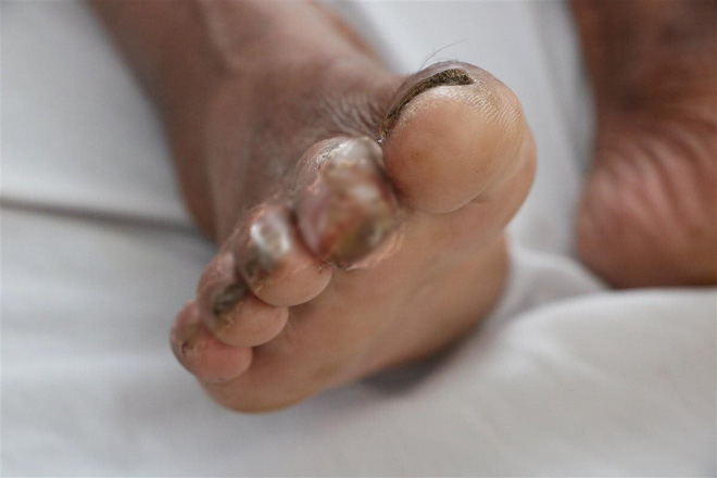 Người đàn ông ở Hà Tĩnh bị vi khuẩn ăn thịt người tấn công ngón chân - Ảnh 2.