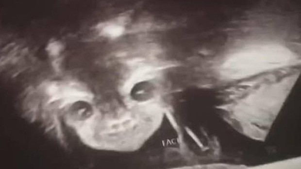 Đi siêu âm thai nhi 24 tuần tuổi, bà mẹ hết hồn khi thấy hình ảnh bé con như đang nhìn chằm chằm mình - Ảnh 1.