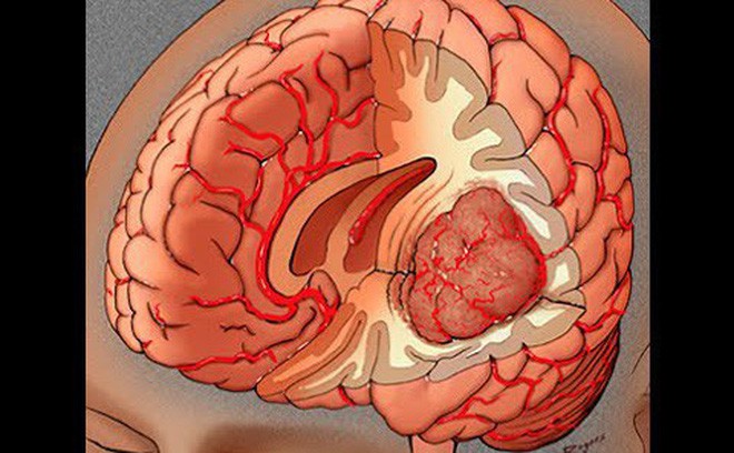 Bác sĩ BV 108: 8 dấu hiệu có thể bạn bị u não, nếu có cần đến viện kiểm tra ngay - Ảnh 2.