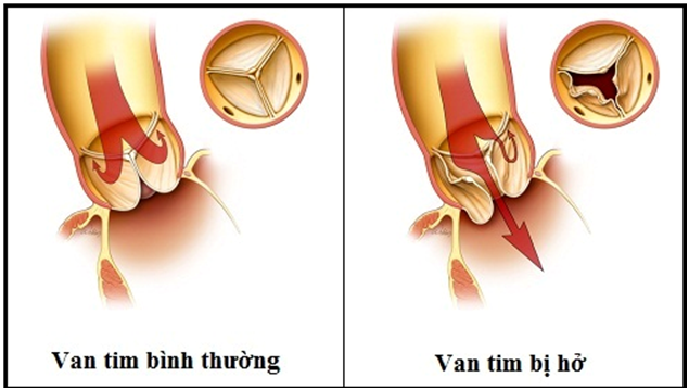 Bệnh hở van tim khiến Tuấn Hưng đang phải nằm viện theo dõi có nguy hiểm không? - Ảnh 4.