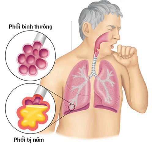 Căn bệnh khiến nam sinh phải mang bình oxy đi thi: Vì sao không thể chẩn đoán ra? - Ảnh 2.